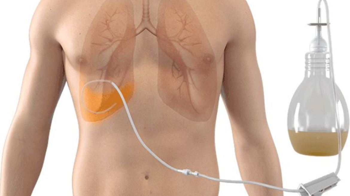 What Is A PleurX Drain?